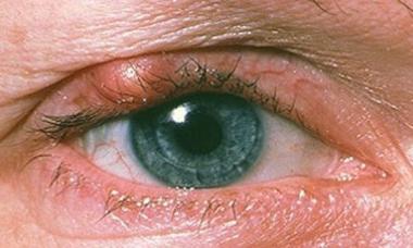 Опухло верхнее веко глаза — что делать, как снять воспаление