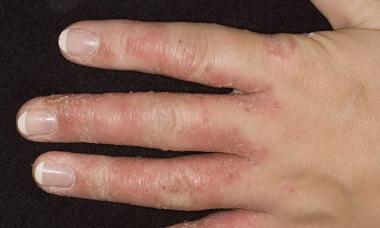 Трещины на пальцах рук: причины появления и способы лечения