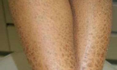 Симптомы и лечение ихтиоза кожи